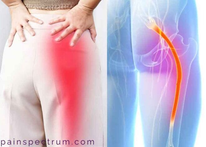 Sciatica: Comprehensive Information, 2024