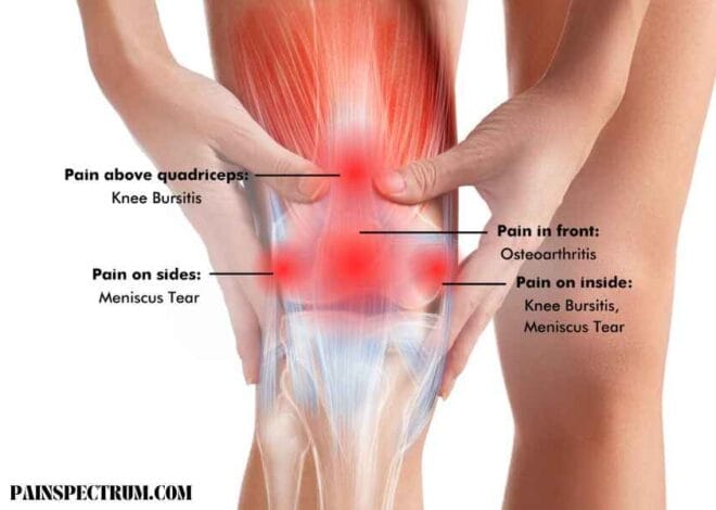 5 Knee Pain Location Chart Best Guide