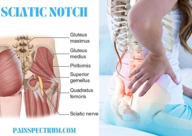 Exploring the Sciatic Notch- Best Guide 2024