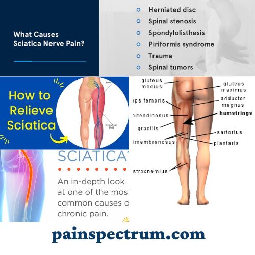 Causes of Sciatica