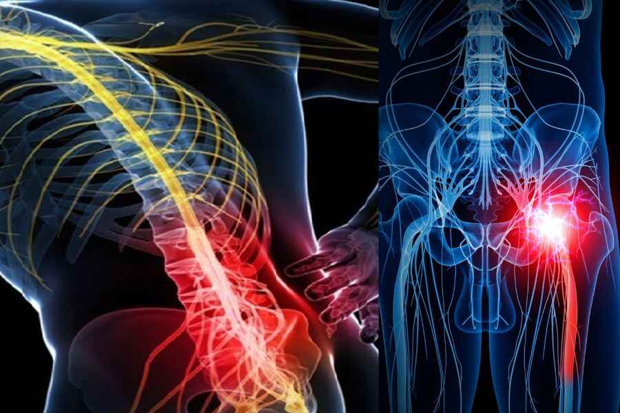 Non-Surgical Treatment Options for Sciatica Pain